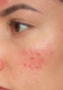 Close-up van een wang met zichtbare roodheid en bultjes als gevolg van rosacea.