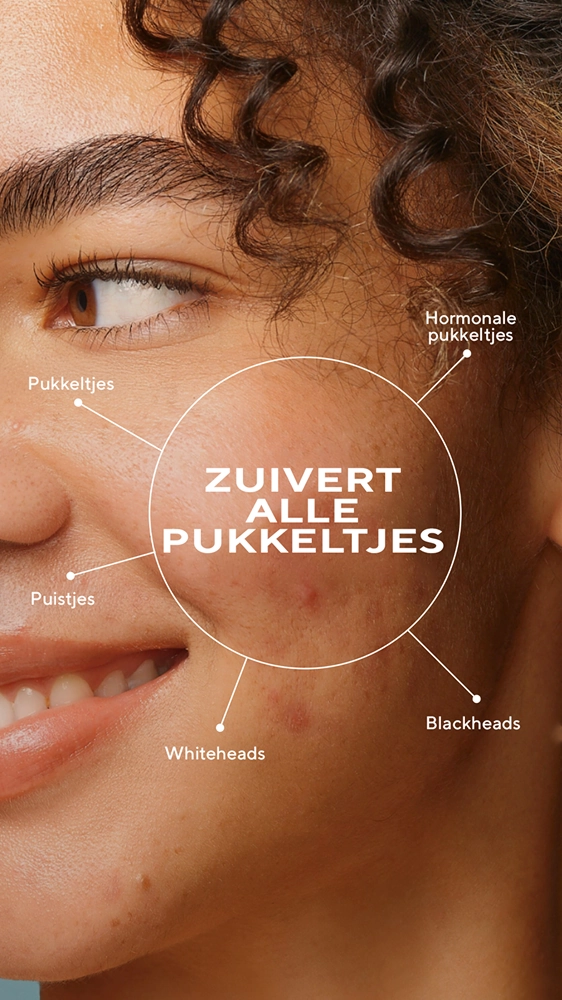 Close-up van een glimlachend gezicht met verschillende soorten puistjes gemarkeerd, omsloten door de tekst "Zuivert alle pukkeltjes".